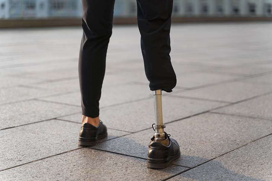 amputation compensation claim, personal injury claim, disabled person with amputee leg